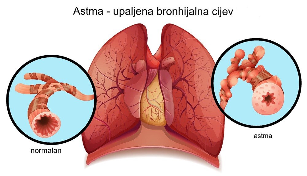 Šta je astma